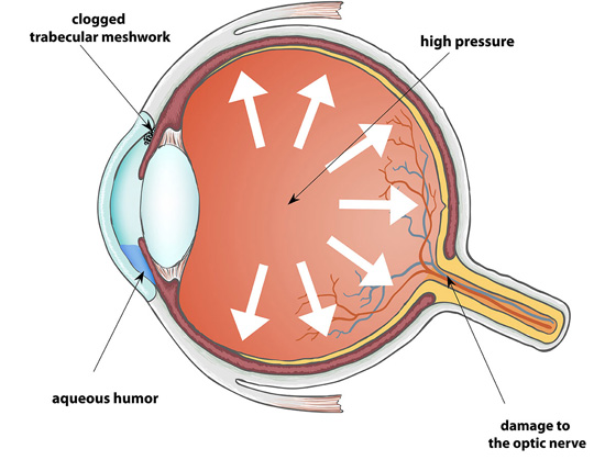 GLAUCOMA