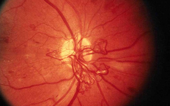 RETINOPATIA DIABETICA